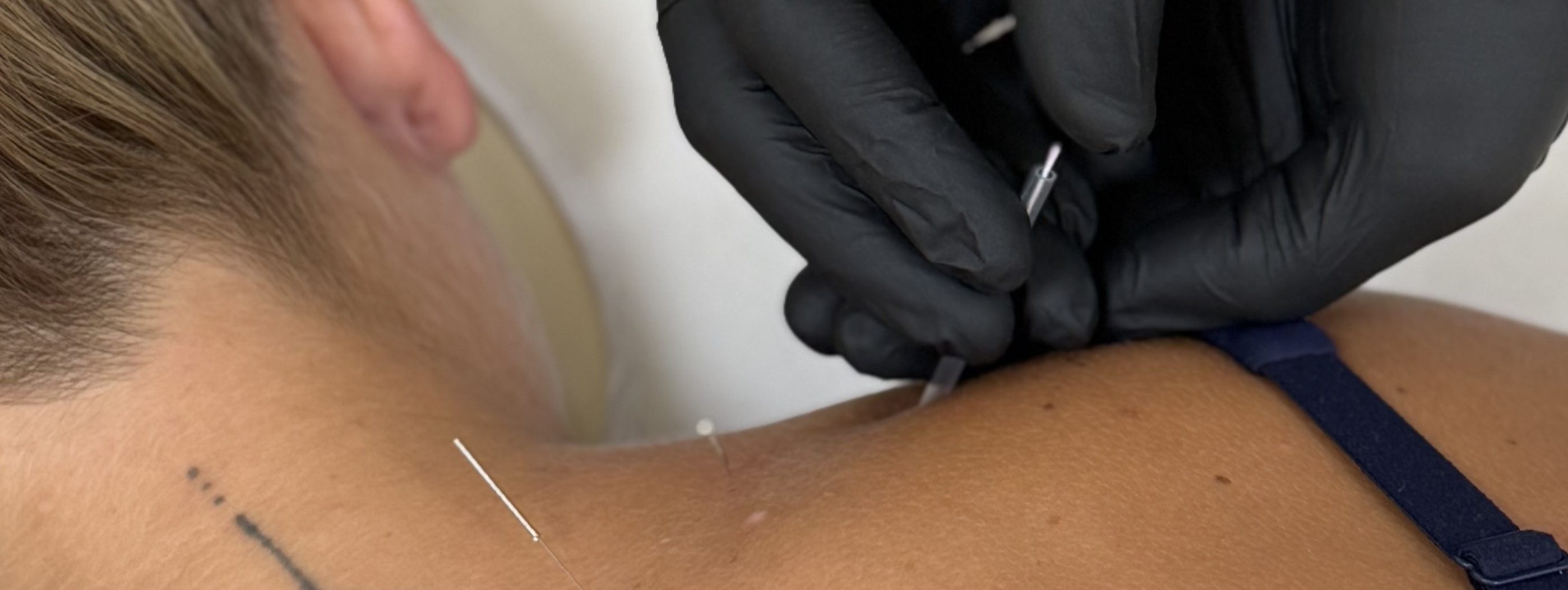 dry needling, fizioterapija trzic, smejic, smejc, terarok, manualna terapija